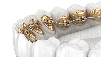 Are Lingual Braces Right for You?